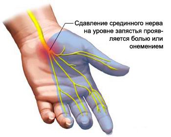Smärta i handen