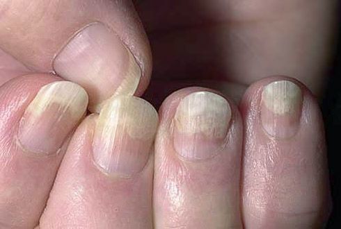 Skal av nagelplattan från mjuka vävnader