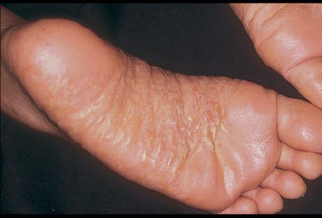 Benens dermatit och dess orsaker