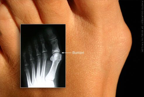 Vulgus deformation av storågen