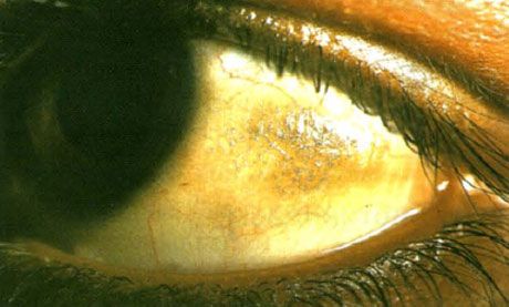 Xeroftalmi.  Bitos plack ser upphöjda, med deponering av flera skalor, konjunktiva platser i en zon som inte täcks av ögonlocken.  Som i detta fall pigmenteras ofta patologiska områden.