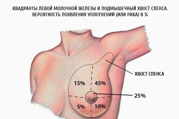 Kvadranterna i vänster bröst och spetsens axillära spence.  Sannolikheten för sälar (eller cancer) i%