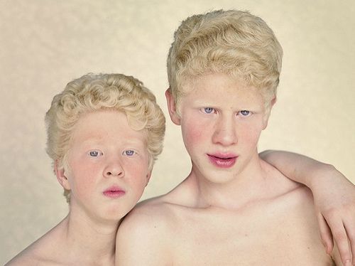 albinism