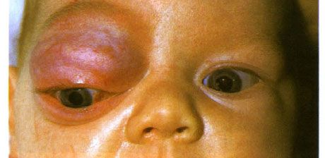 Kapillär hemangiom i den främre delen av banan och övre ögonlocket.  Neoplasm tenderar att utvecklas