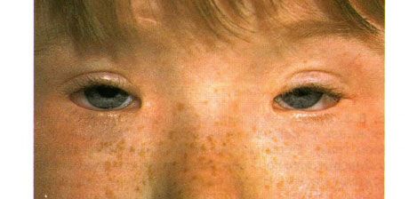 Syndrom av blepharophimosis.  Dubbelsidig ptosis, telecanthus och blepharophimosis