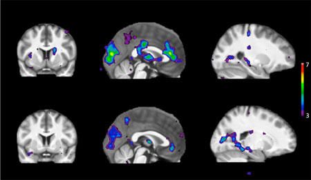 Skanning visar områden av hjärnaktivitet som svar på stimuli hos personer med snabb metabolism av nikotin (övre raden) och en långsam metabolism av nikotin (nedre raden)