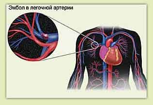 Lungemboli och bröstsmärta till vänster