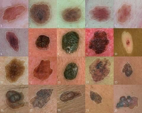 Forskare har hittat en gen som spelar en central roll i utvecklingen av melanom