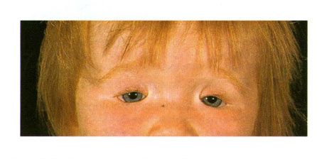 Dubbelsidig kolobom i ögonlocken i ett barn med Gulds syndrom.  Avslutande av ögonslitsen till vänster