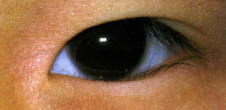 Epiblefaron.  Felaktig tillväxt av ögonfransarna firas från födseln.  Ibland finns det en spontan förbättring